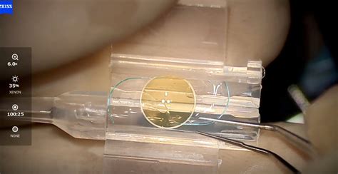 Image result for Light Adjustable Lens Problems