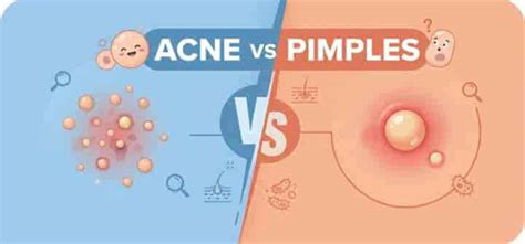 Acne vs pimples: Understanding the key differences for better skin care