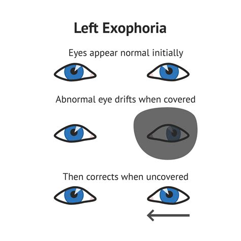 When examining the eye of a patient with strabismus, the uncover test ...