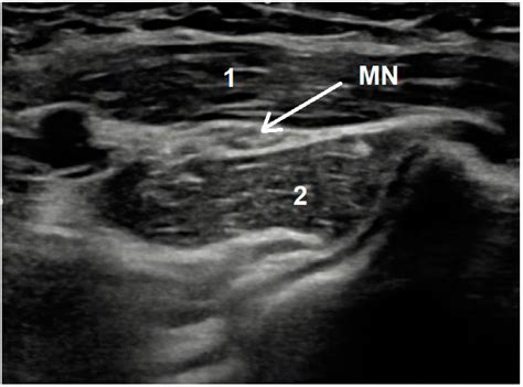 How to Differentiate Pronator Syndrome from Carpal Tunnel Syndrome: A ...