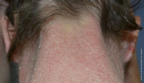 Eczema de la cara y el cuello | Fundación Eczema