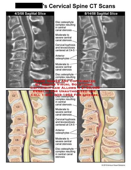 AMICUS Illustration of amicus,injury,cervical,spine,CT,scans,disc ...