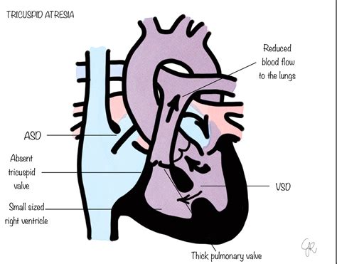 Tricuspid Atresia | SCTS