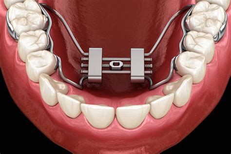 Palatal Expansion for Kids and Adults FAQs | Greg Brown Ortho