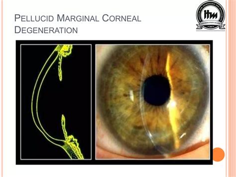 Corneal degeneration ppt | PPTX