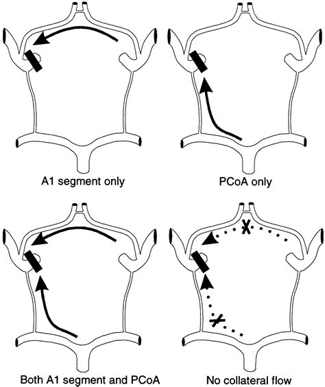 Collateral Ability of the Circle of Willis in Patients With Unilateral ...