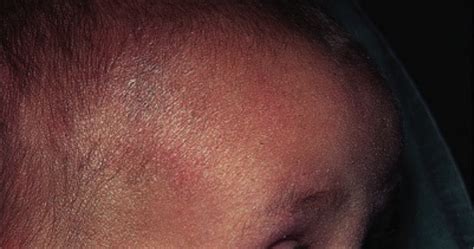 Aura Skin Clinic - Visakhapatnam: DO’s and Don’ts in Atopic Dermatitis ...