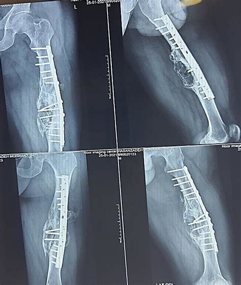 Eccentric Dynamic Compression Plate 的图像结果