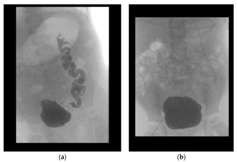 Children | Special Issue : Abdominal Surgery in Pediatrics Update