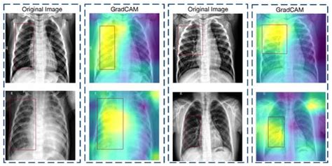 A Deep Convolutional Neural Network for Pneumonia Detection in X-ray ...
