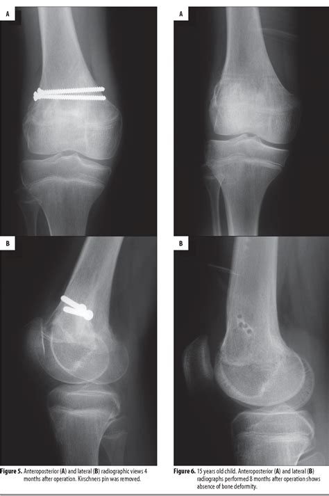 Figure 5 from Salter-Harris type II fracture of the femoral bone in a 14-year-old boy – case ...