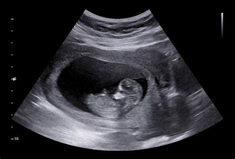 First Ultrasound Pregnancy