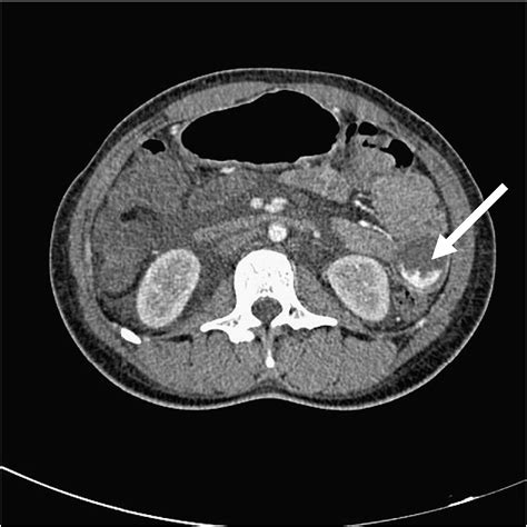 An uncommon cause of life-threatening gastrointestinal bleeding: 2 synchronous Dieulafoy lesions ...