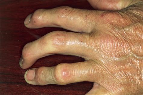Psoriatic Arthritis Icd 10 Data at Juan Chandler blog