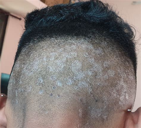Scalp Dandruff 的图像结果