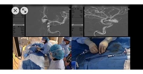 Aneurysm Operation Brain