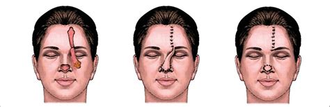 Der „Sashimi-Flap“ – eine Modifikation des bekannten Stirnlappens ...