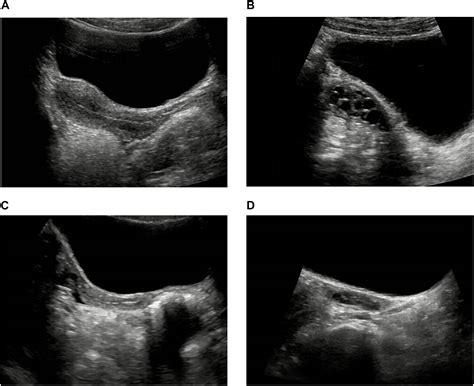 Normal Ovary Ultrasound