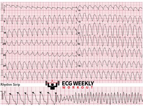 Image result for Synchronized Cardioversion Rhythm Strip