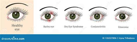 Image result for Common Eye Problems