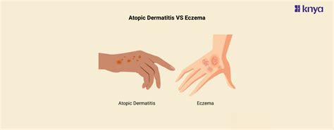 Atopic Dermatitis vs Eczema: Cracking the Itchy Code – Knya