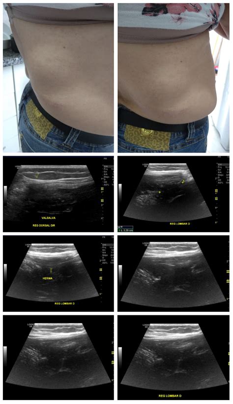 Case of the Month September 2020- Bulging of the right flank of the abdomen – WFUMB