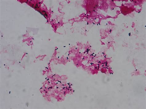 Streptococcus pneumoniae〔肺炎球菌〕 | グラム染色: Gram Stain
