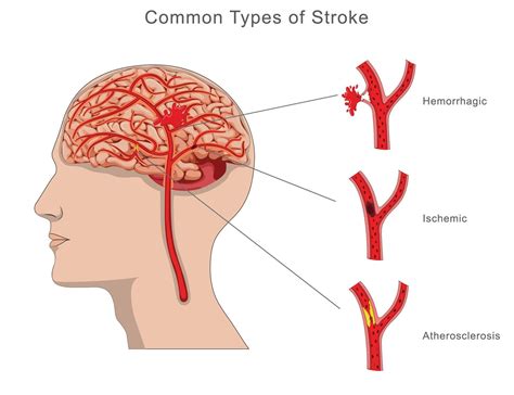 Illustration of common types of Brain stroke, including ischemic, hemorrhagic, and transient ...