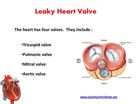 Asian Heart Institute - Leaky heart valve symptoms | PPTX