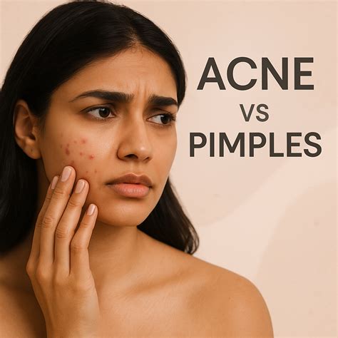 Acne vs Pimples - Key Differences, Remedies and Treatment Options