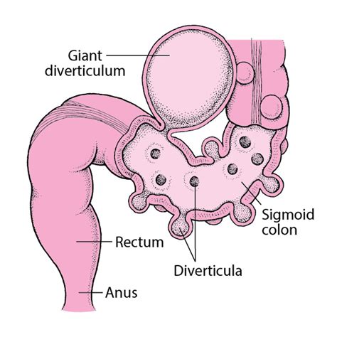 Diverticulosis of the Large Intestine - Digestive Disorders - Merck ...