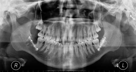 Perils of intermaxillary fixation screws | Pocket Dentistry