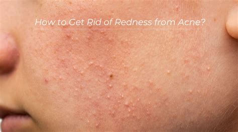 How to Get Rid of Redness from Acne: A Comprehensive Guide – Long Story