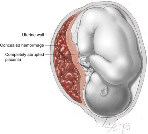 Placenta Previa Vs Abruptio