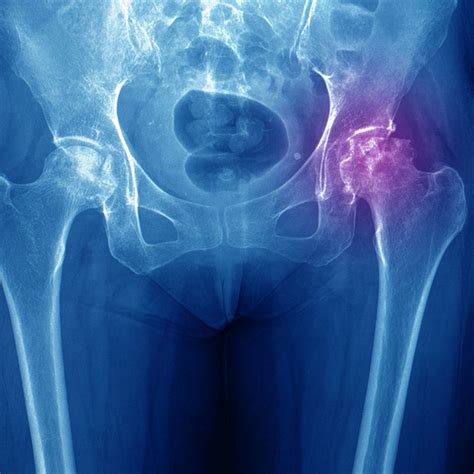 What Is An Avascular Nodule at Kenneth Locke blog