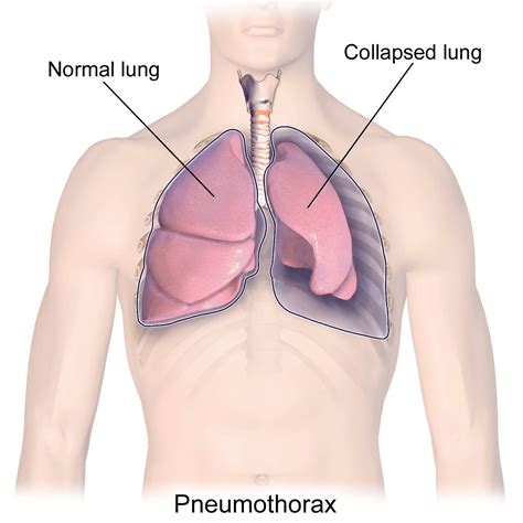 Pneumothorax vs Hemothorax: Difference and Comparison