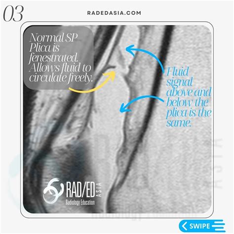 KNEE MRI PLICA SUPRAPATELLAR BURSA LIPOHEMARTHROSIS - Radedasia