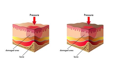 Identifying and managing a stage 1 pressure ulcer in nursing homes