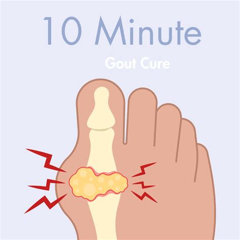 Gout Treatment In Foot Uk