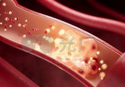 Image result for thrombolysis 血栓溶解