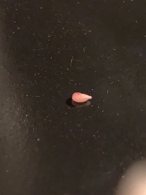 Cyst at Home Burst 的图像结果