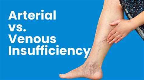 Arterial vs. Venous Insufficiency - Rosen Vein Care
