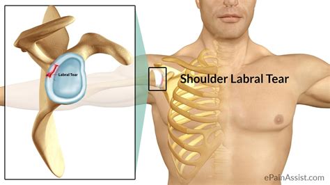 Image result for Shoulder Labral Tear Surgery