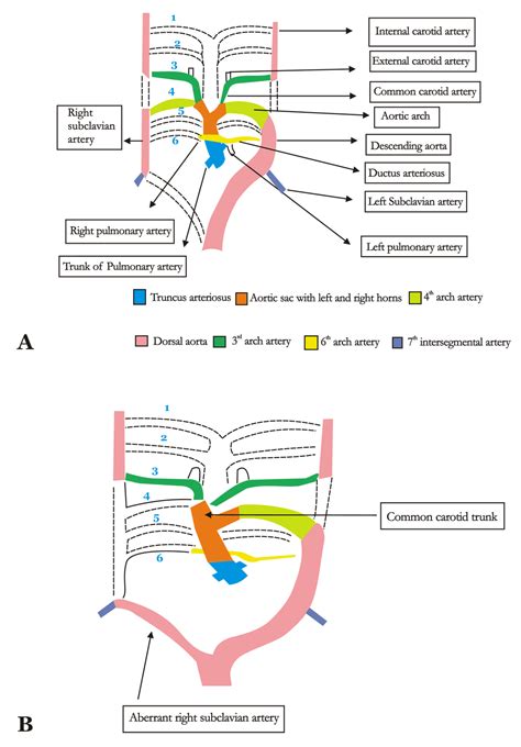 FULL TEXT - Right subclavian steal syndrome in a patient with aberrant ...