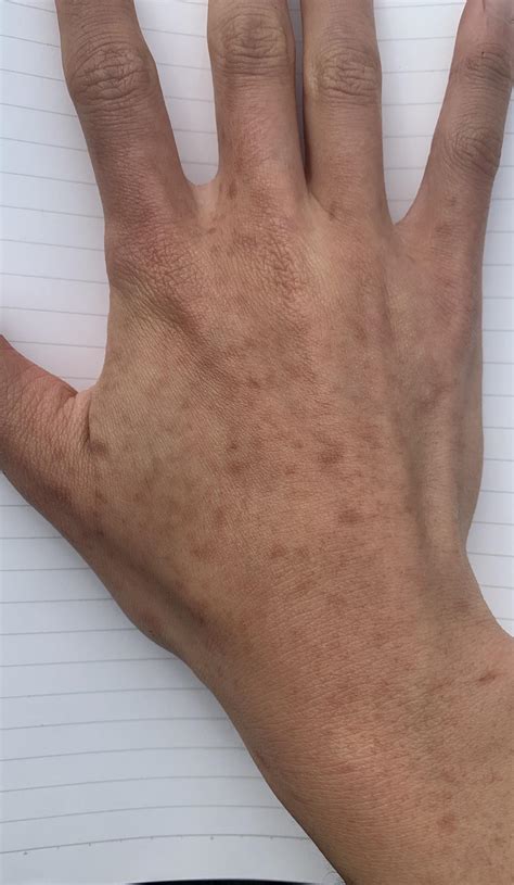 What are these brown spots that suddenly appeared on the back of my hands? (not itchy, smooth ...