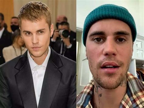 Justin Bieber diagnosed with Ramsay Hunt Syndrome