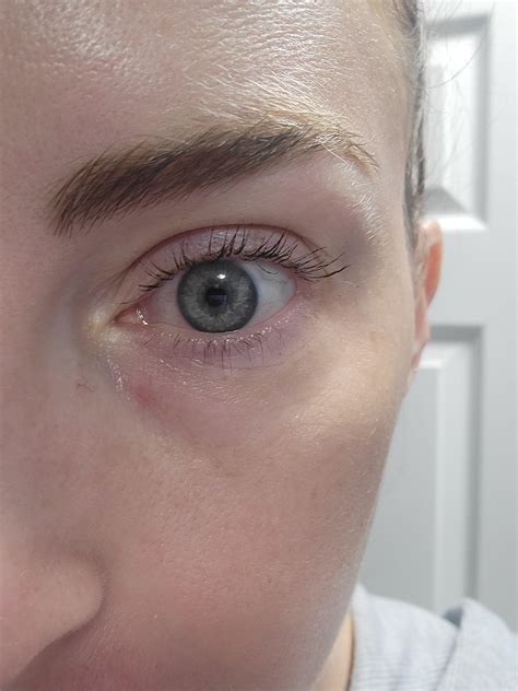 Help! I keep getting these weird pimple-like bumps below my eye : r/30PlusSkinCare