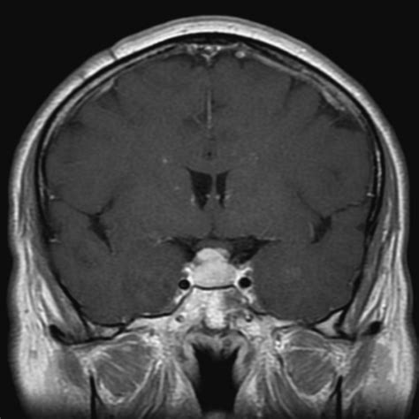Pure endoscopic transsphenoidal surgery for functional pituitary adenomas: outcomes with Cushing ...