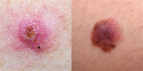 Types Skin Cancer Signs 的图像结果