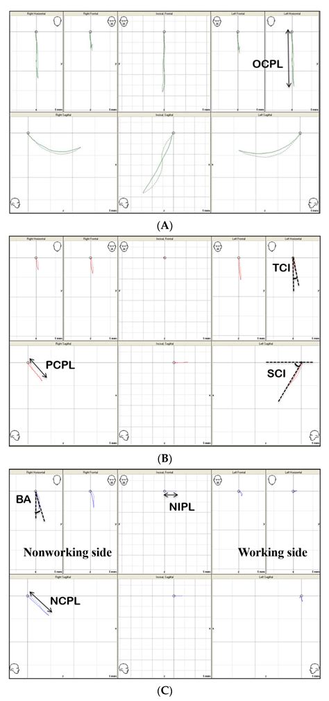 Automated Real-Time Evaluation of Condylar Movement in Relation to ...